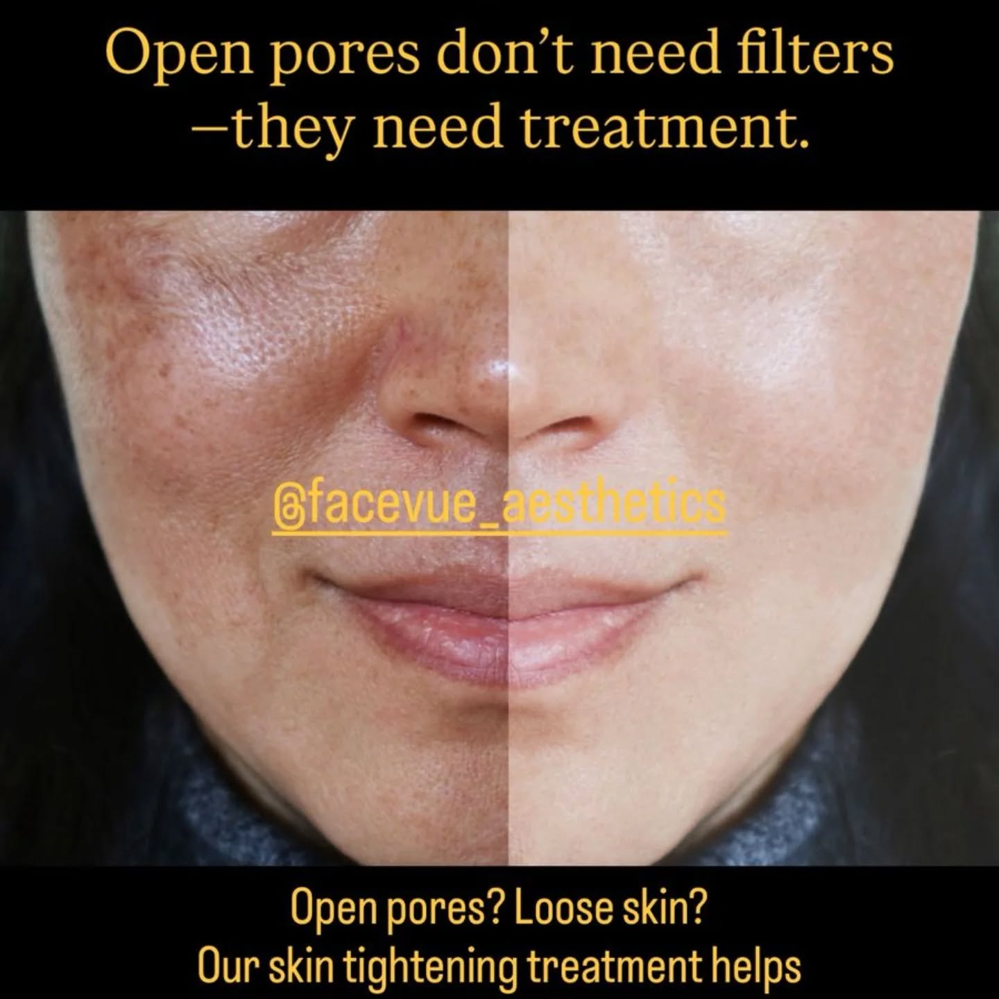 Skin tightening that refines pores and restores confidence.
 #SkinTighteningResults #PoreRefinement
#NoFilterGlow #AestheticClinic
#LuxurySkinCare GlassSkinLook
MakeupFreeConfidence SkinTransformation